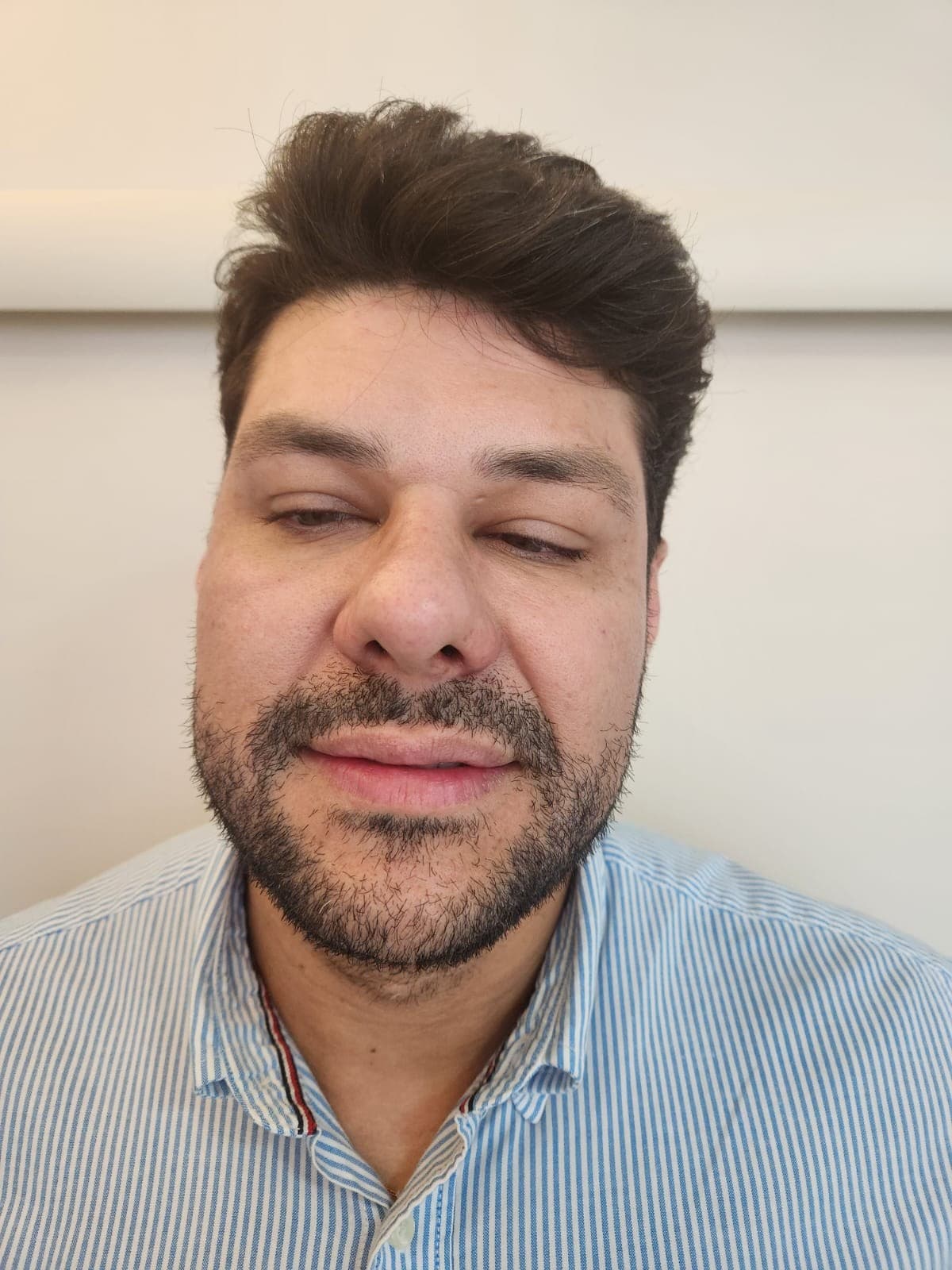 Antes do tratamento: terço inferior do rosto